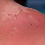 Cinci arsuri solare pot dubla riscul de melanom, avertizează medicii