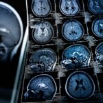 Programul de 10 săptămâni a redus ceața cerebrală la pacienți cu Long COVID