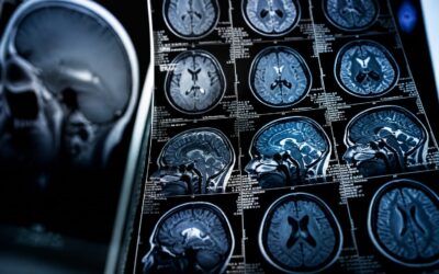 Programul de 10 săptămâni a redus ceața cerebrală la pacienți cu Long COVID