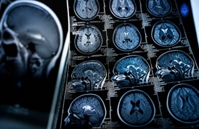 Programul de 10 săptămâni a redus ceața cerebrală la pacienți cu Long COVID